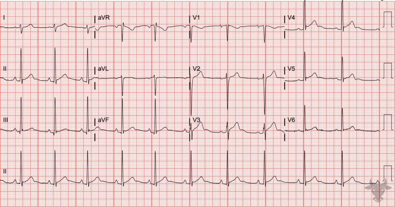 Early Repolarization ECG Stampede