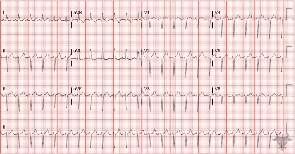 Supraventricular Tachycardia Ecg Stampede