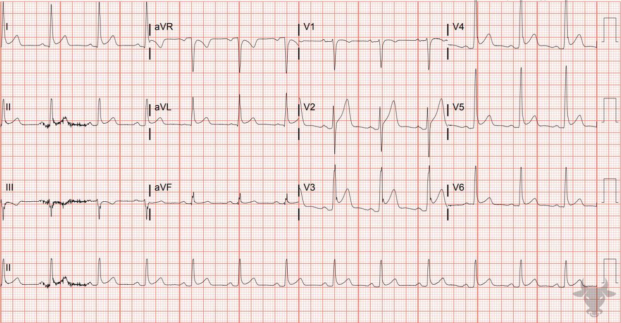 Early Repolarization Ecg Stampede