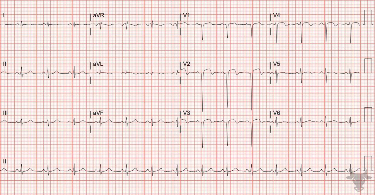 Left Ventricular Aneurysm ECG Stampede