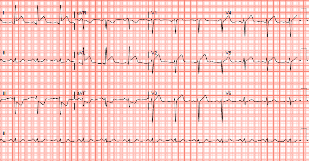 ECG Assessment | ECG Stampede