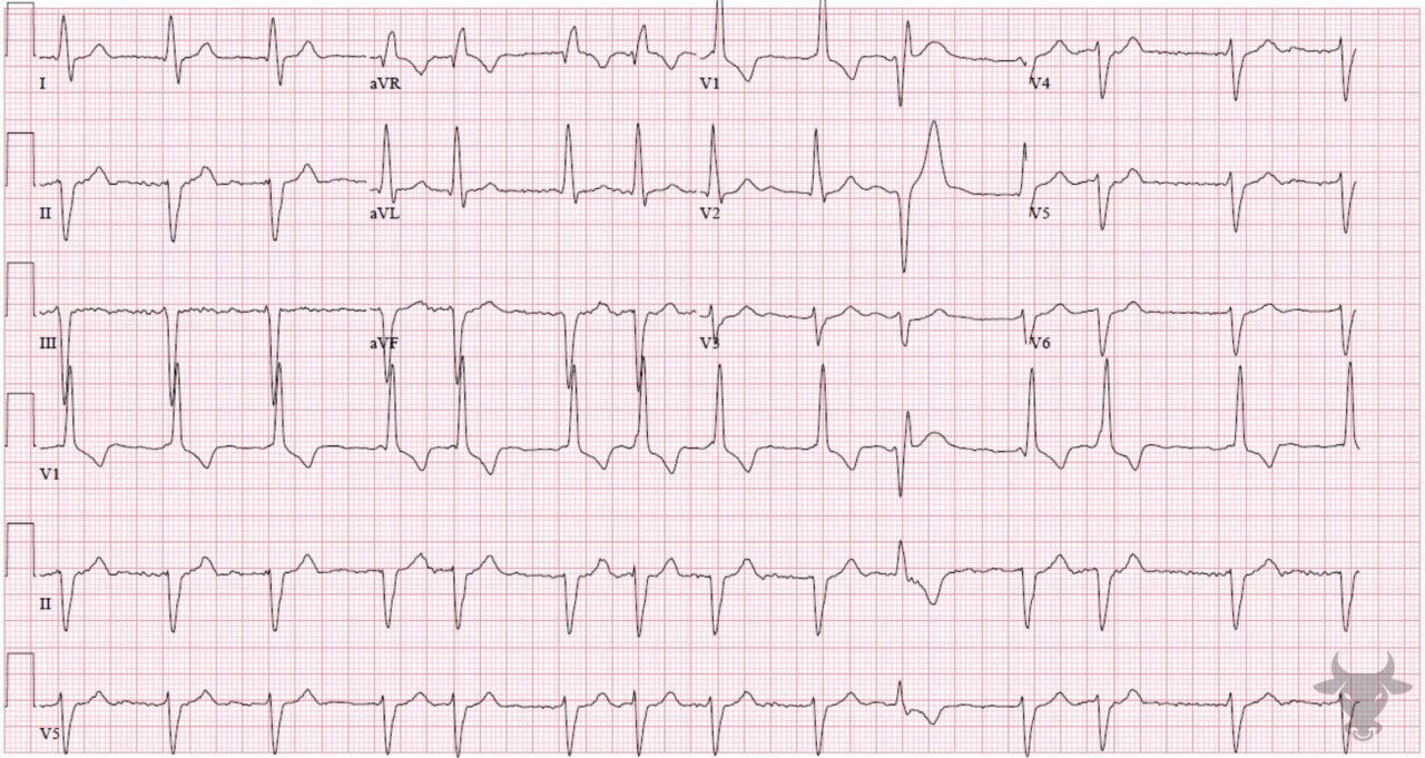 Bifascicular Block | ECG Stampede