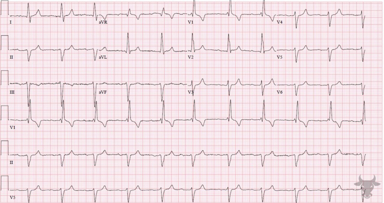 Trifascicular Block | ECG Stampede