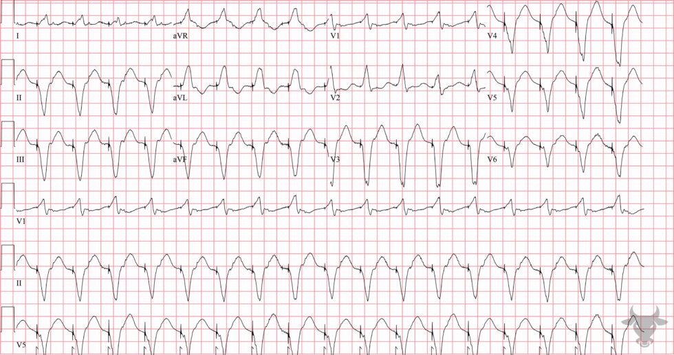 Pacemaker Mediated Tachycardia | ECG Stampede