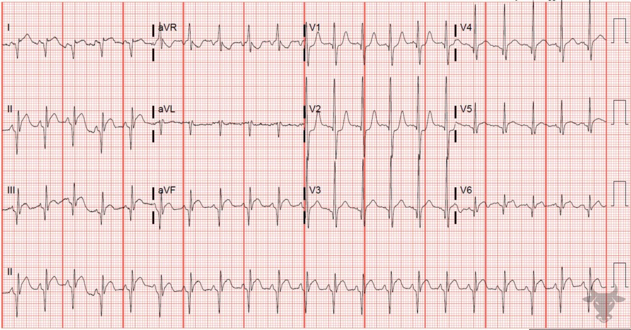 Dextrocardia | ECG Stampede