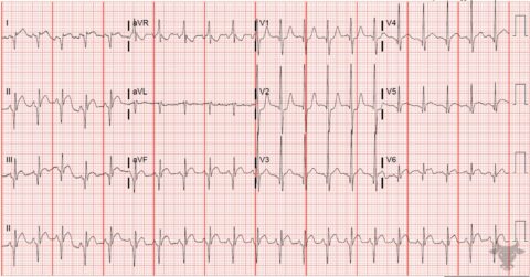 Dextrocardia | ECG Stampede