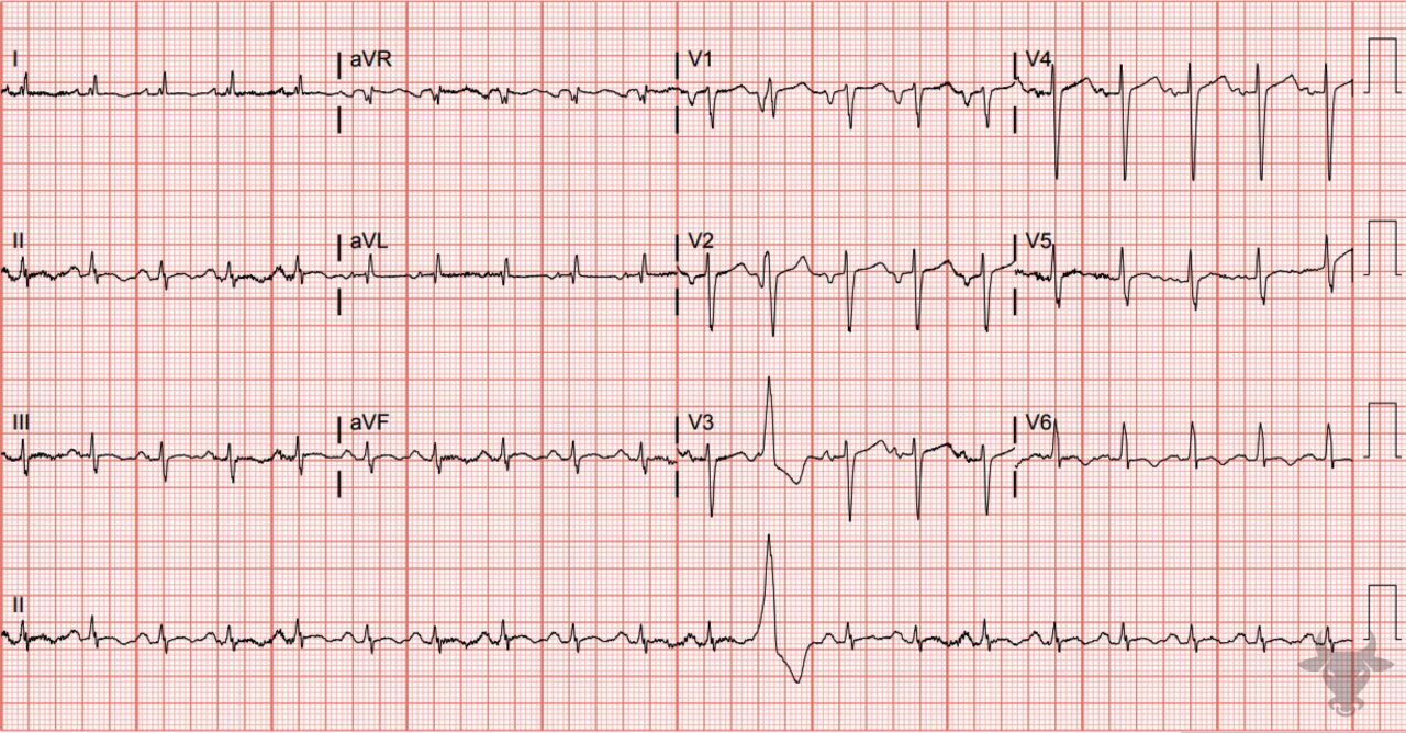 left-atrial-enlargement-ecg-stampede