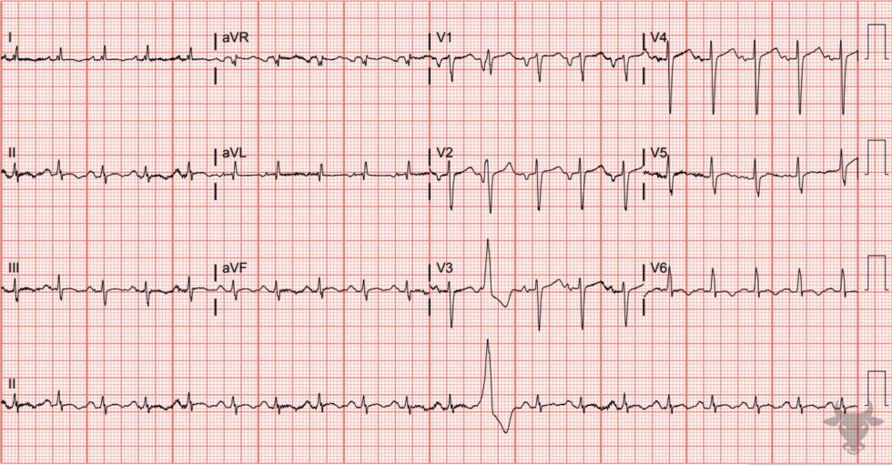 Left Atrial Enlargement | ECG Stampede