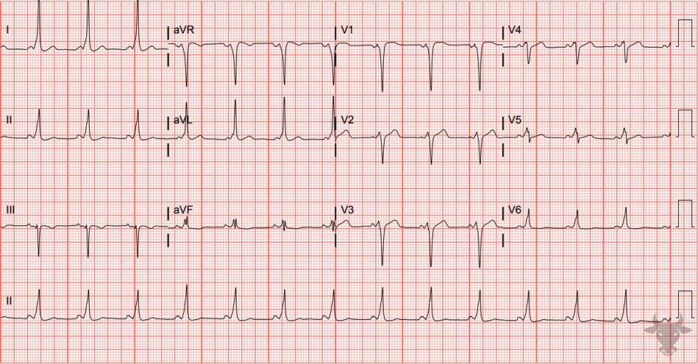 Ventricular Pre-excitation | ECG Stampede