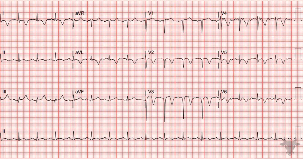 T-wave Inversions | ECG Stampede