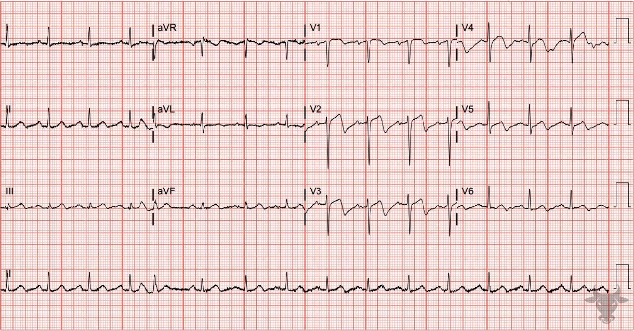 Wellens Syndrome | ECG Stampede