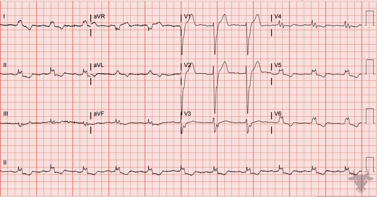 Left Bundle Branch Block | ECG Stampede