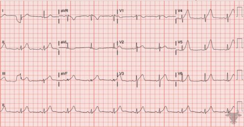 Hyperacute T Waves | ECG Stampede