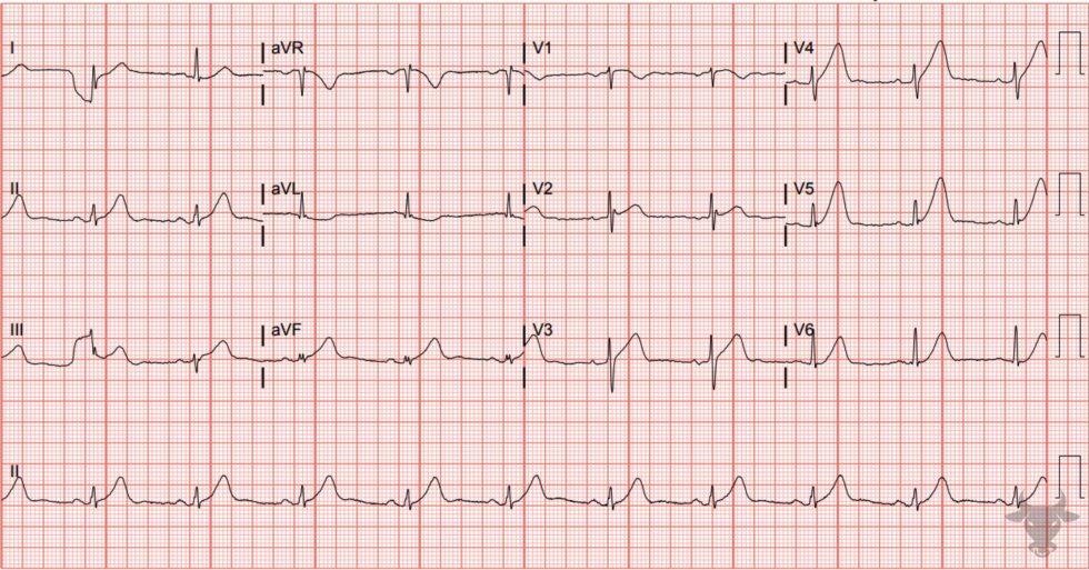 Hyperacute T Waves | ECG Stampede