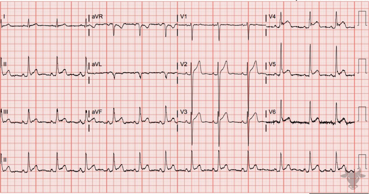 Acute Pericarditis | ECG Stampede