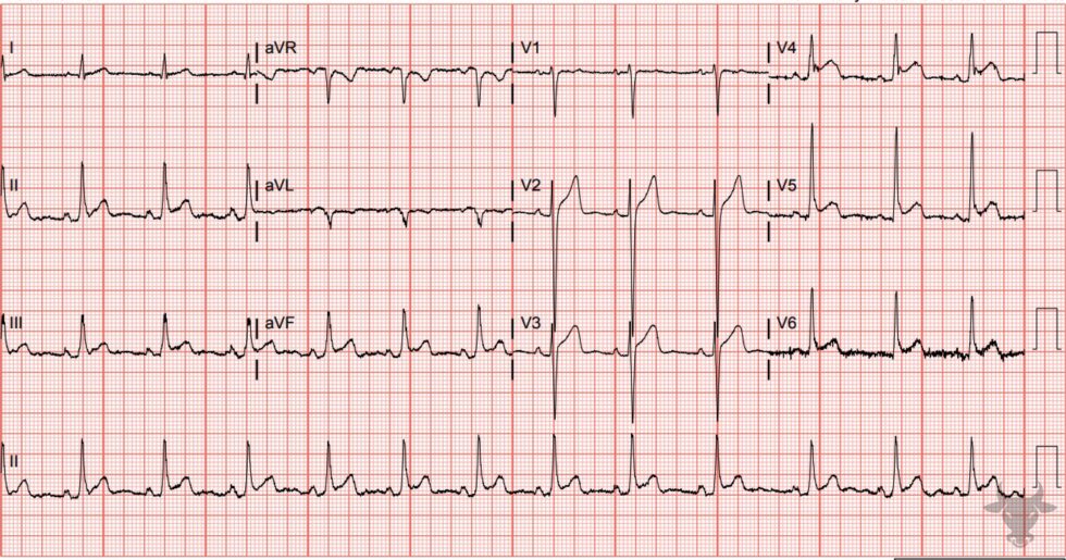 Acute Pericarditis | ECG Stampede