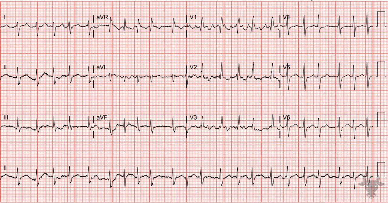 Left Posterior Fascicular Block | ECG Stampede