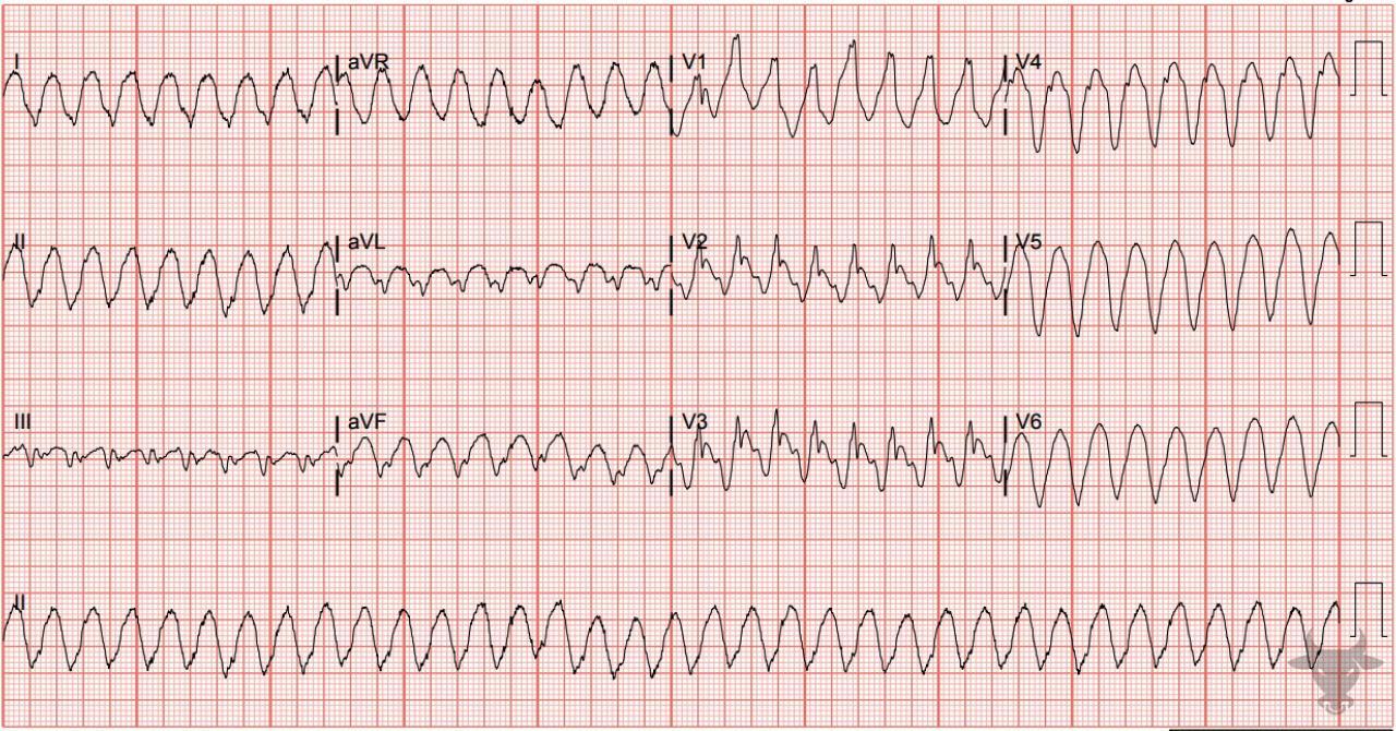 Ventricular Tachycardia | ECG Stampede