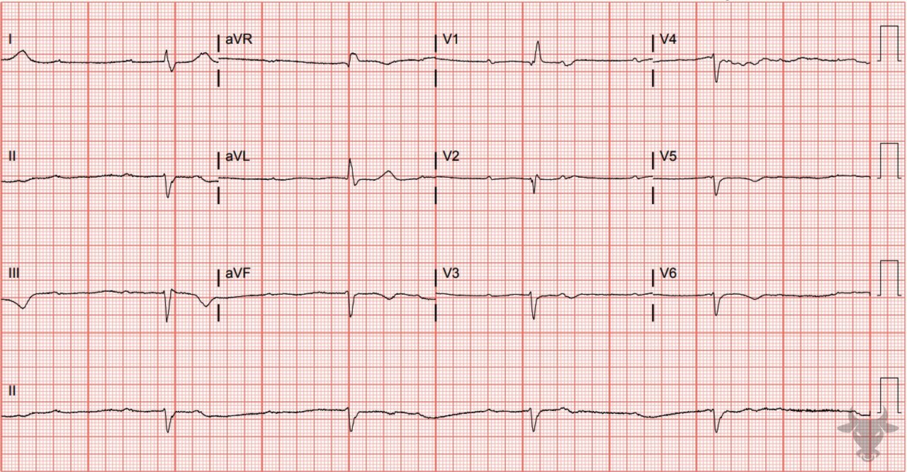 Third Degree Atrioventricular Block 