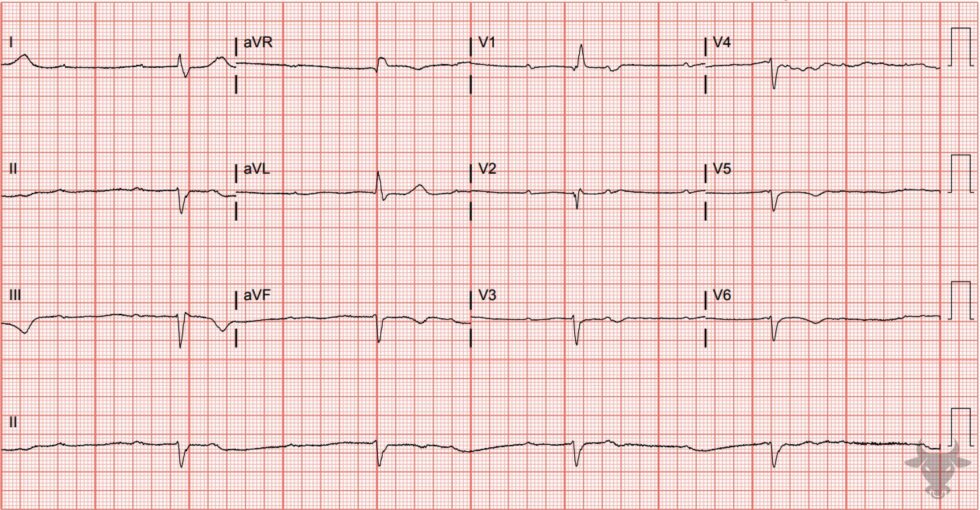 Third Degree Atrioventricular Block | ECG Stampede