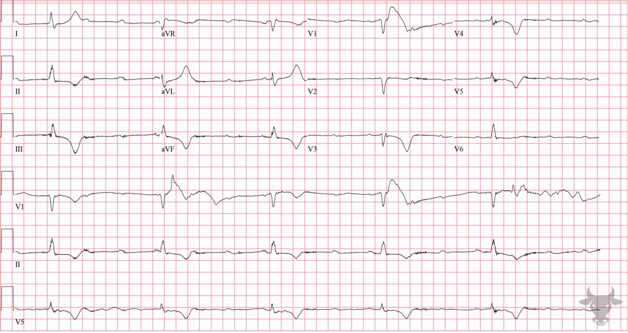 Third Degree Atrioventricular Block | ECG Stampede