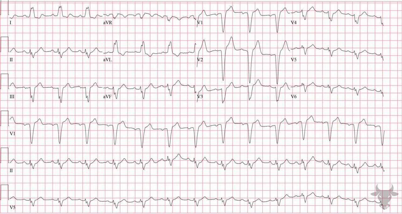 First Degree Atrioventricular Block | ECG Stampede