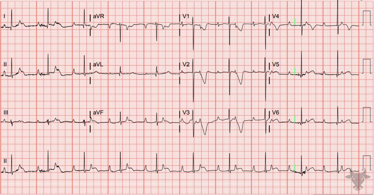 Third Degree Atrioventricular Block | ECG Stampede