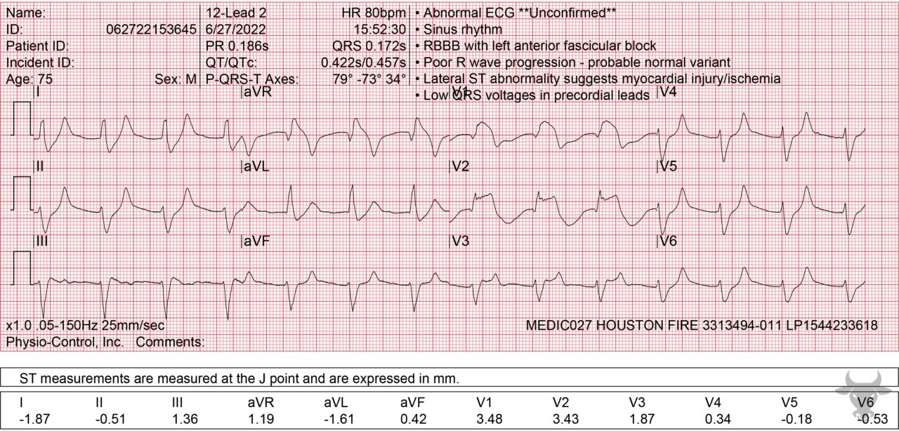 Hyperkalemia | ECG Stampede