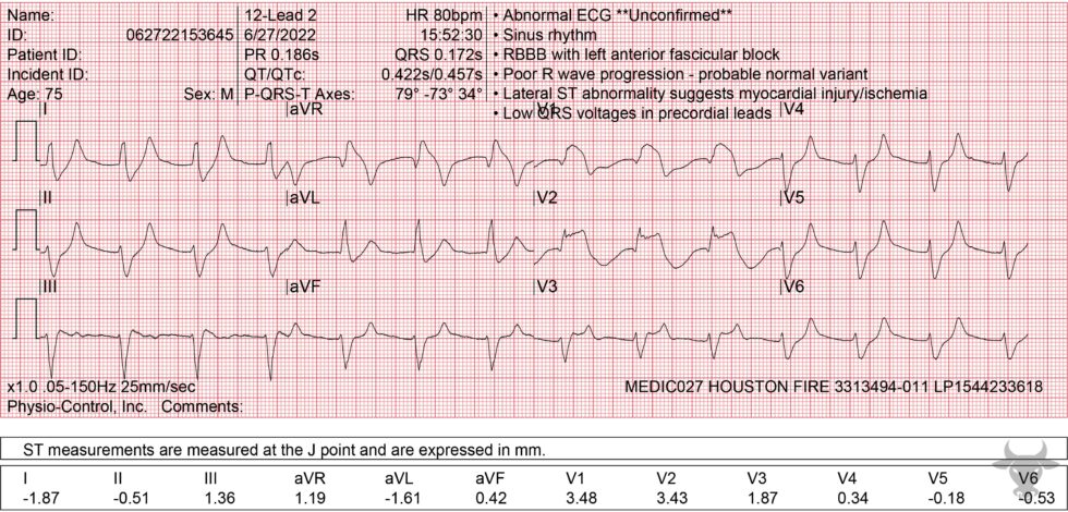 Hyperkalemia | ECG Stampede