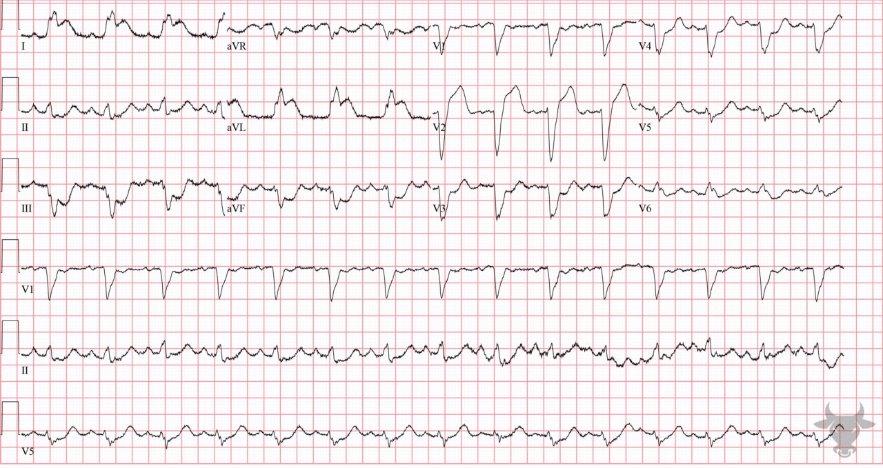 Sgarbossa Criteria | ECG Stampede