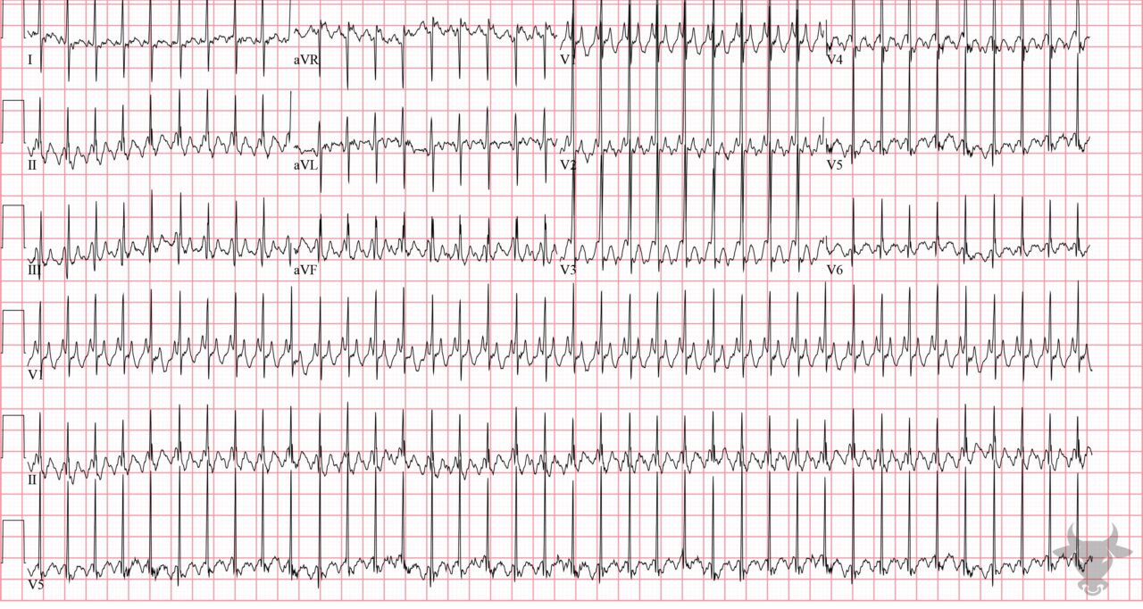 Atrial Flutter | ECG Stampede