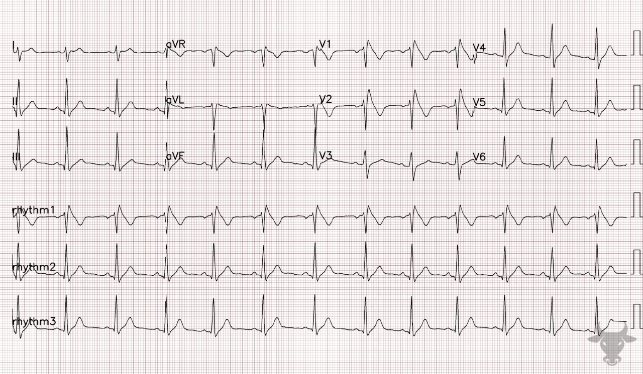 Brugada Syndrome | ECG Stampede