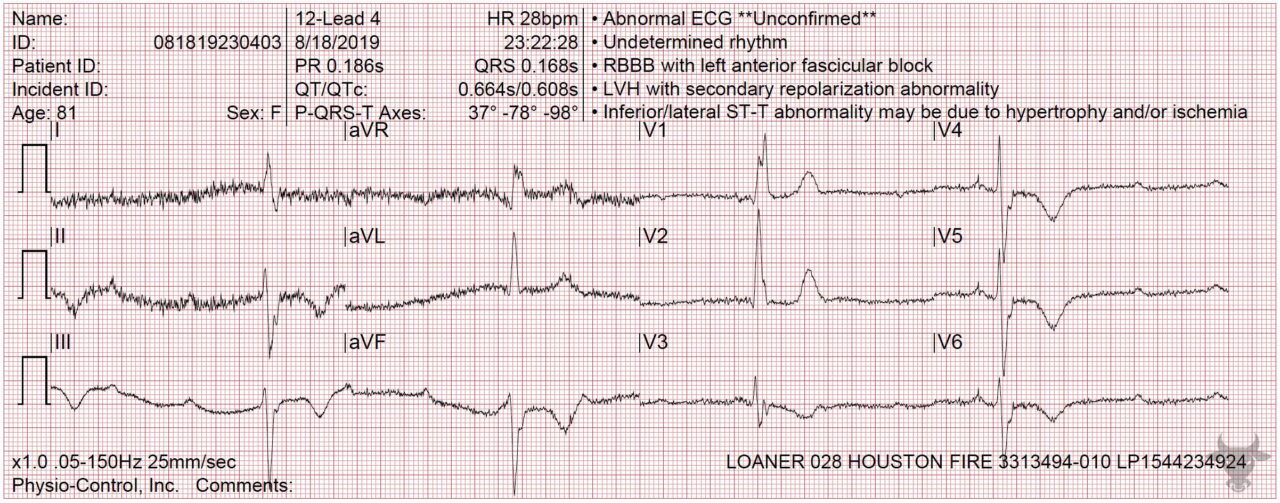 Third Degree Atrioventricular Block | ECG Stampede