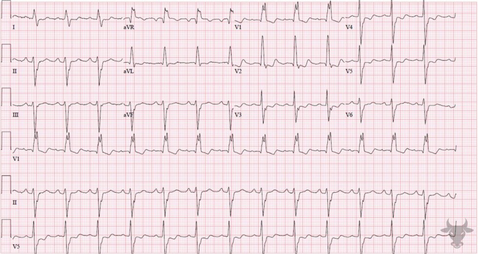 Trifascicular Block | ECG Stampede