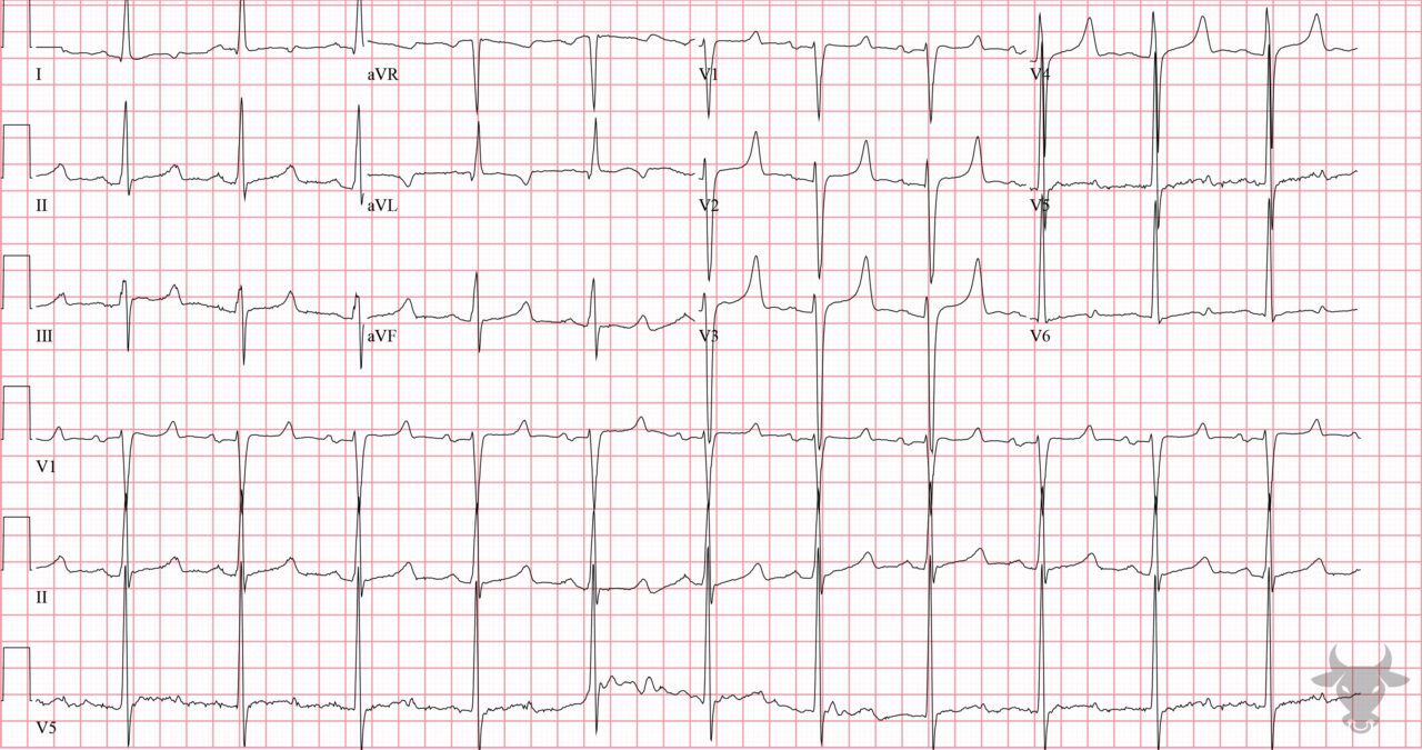 Hypocalcemia | ECG Stampede