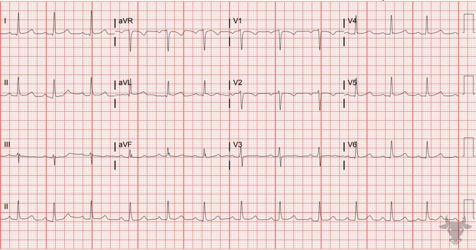 First Degree Atrioventricular Block | ECG Stampede