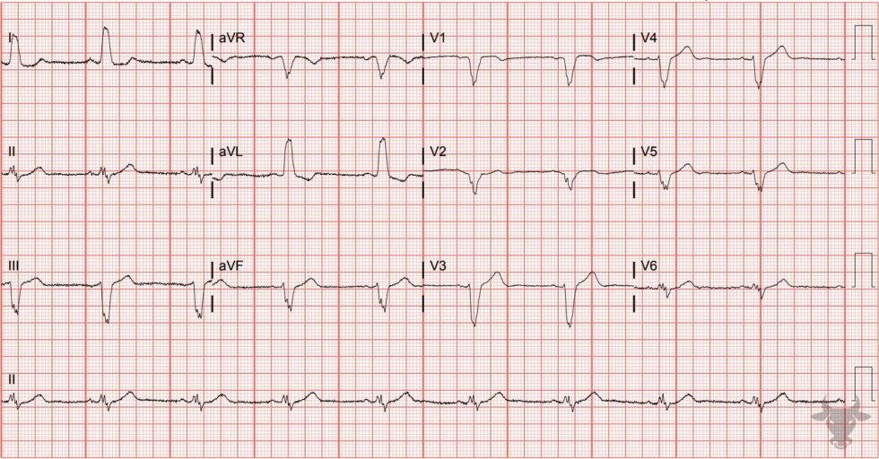 Left Bundle Branch Block 