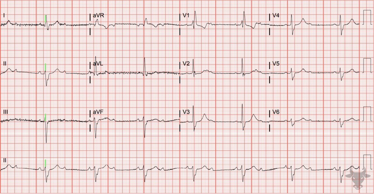 Right Bundle Branch Block | ECG Stampede