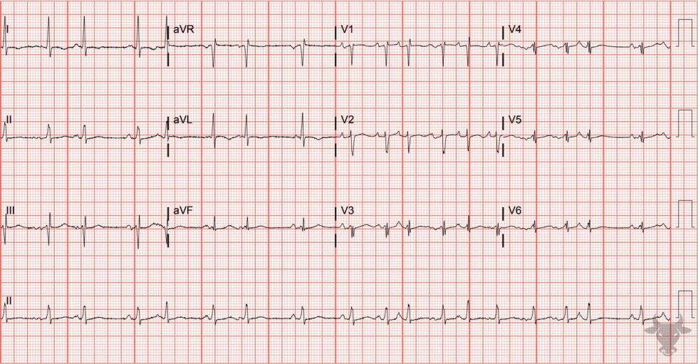 Low Voltage | ECG Stampede