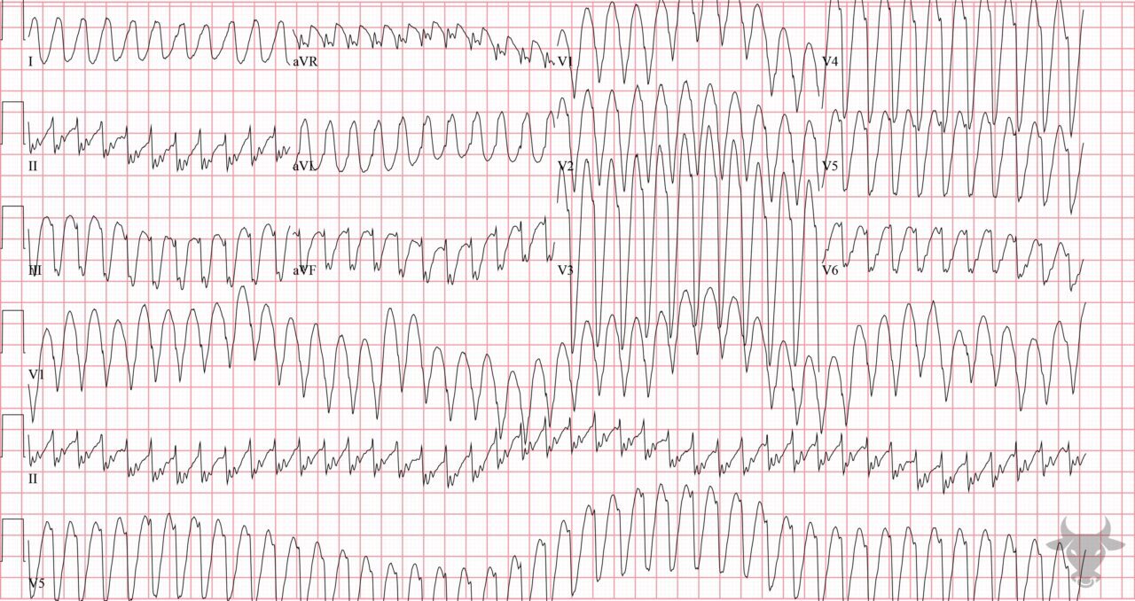 Ventricular Tachycardia 