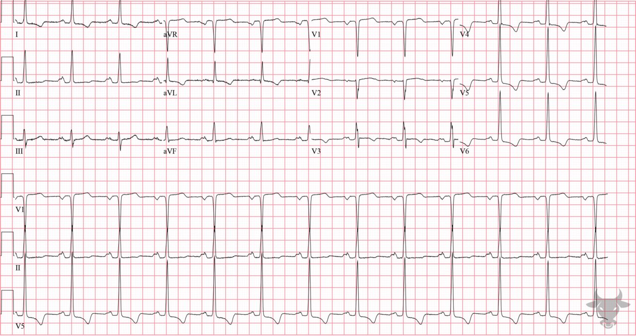 Hypertrophic Cardiomyopathy | ECG Stampede