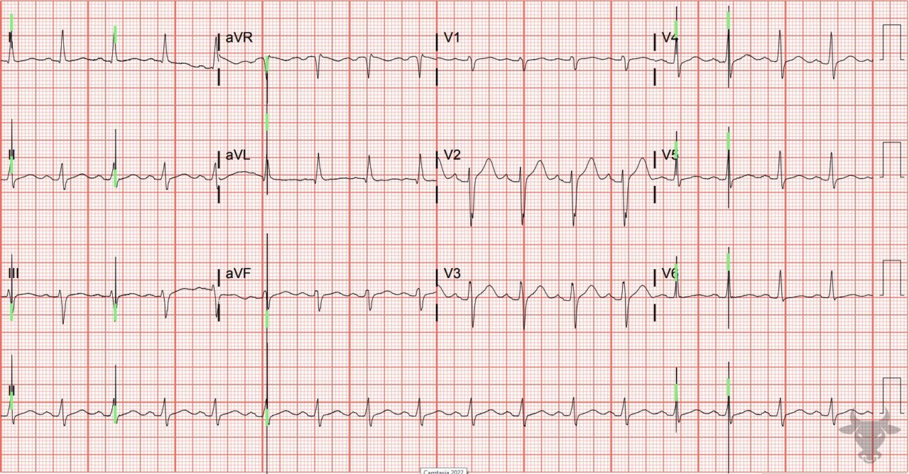 Pacemaker Malfunction | ECG Stampede