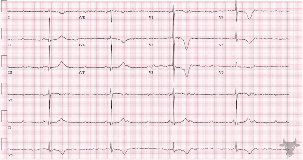 Second Degree Atrioventricular Block – Mobitz II | ECG Stampede