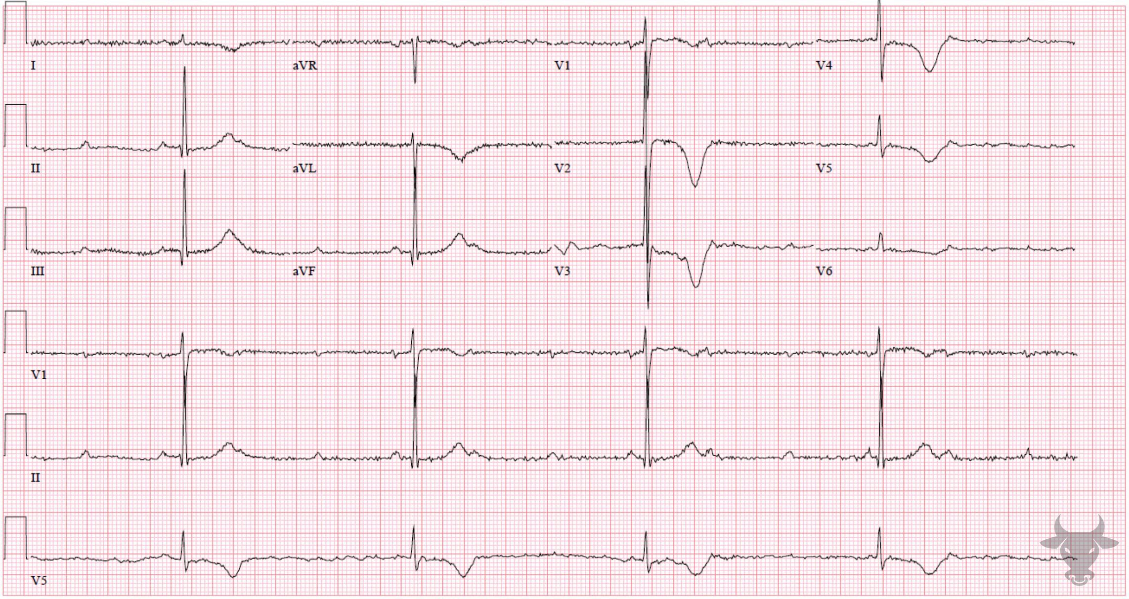 Second Degree Atrioventricular Block Mobitz II ECG Stampede