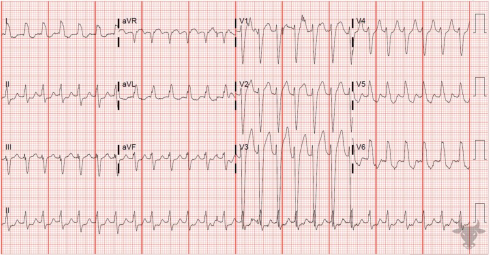 Supraventricular Tachycardia with Aberrancy | ECG Stampede