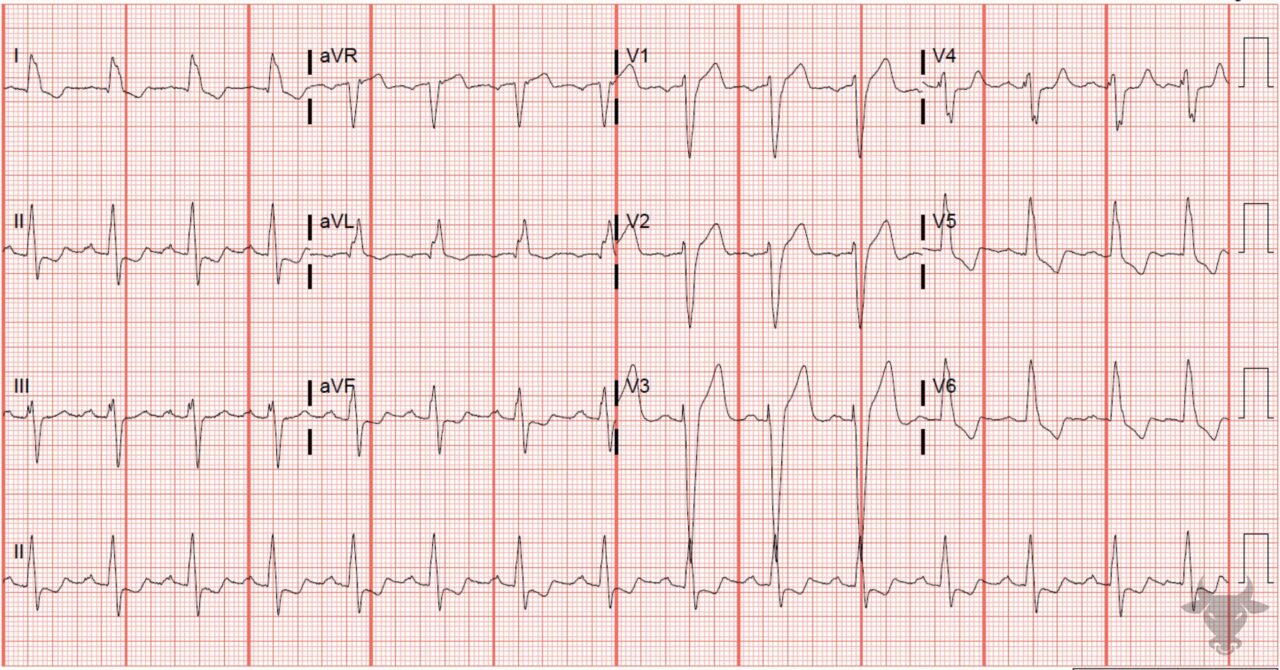 Left Bundle Branch Block | ECG Stampede