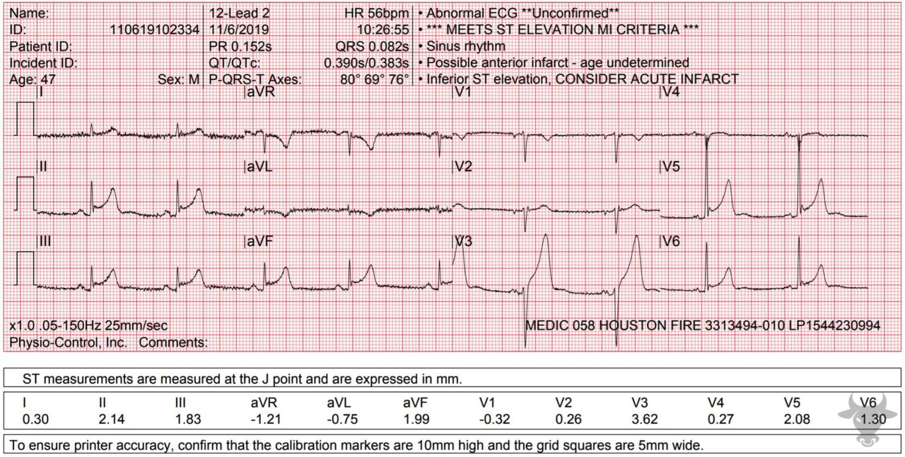 St Elevation Myocardial Infarction Ecg Stampede