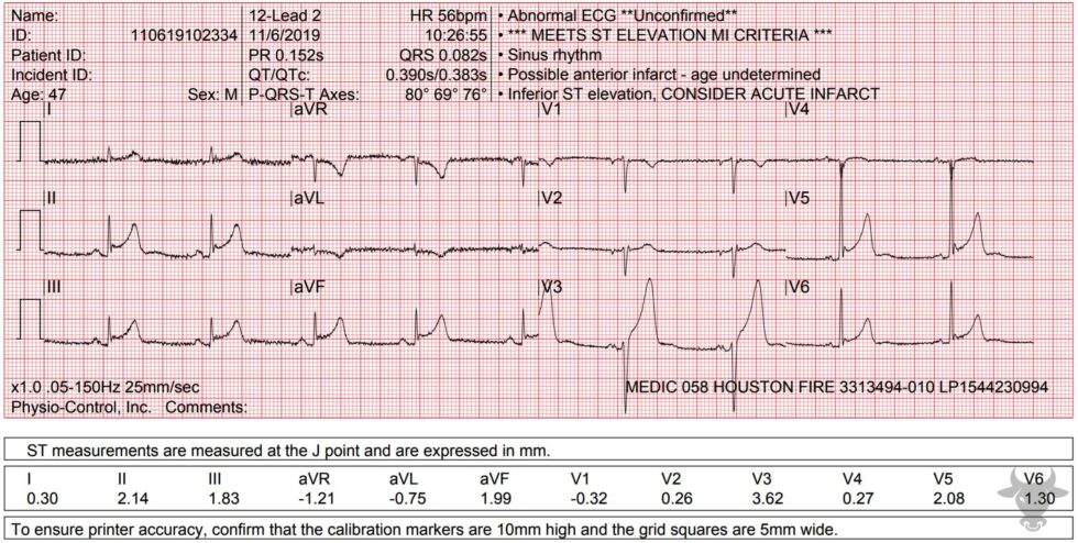 ST-elevation Myocardial Infarction | ECG Stampede