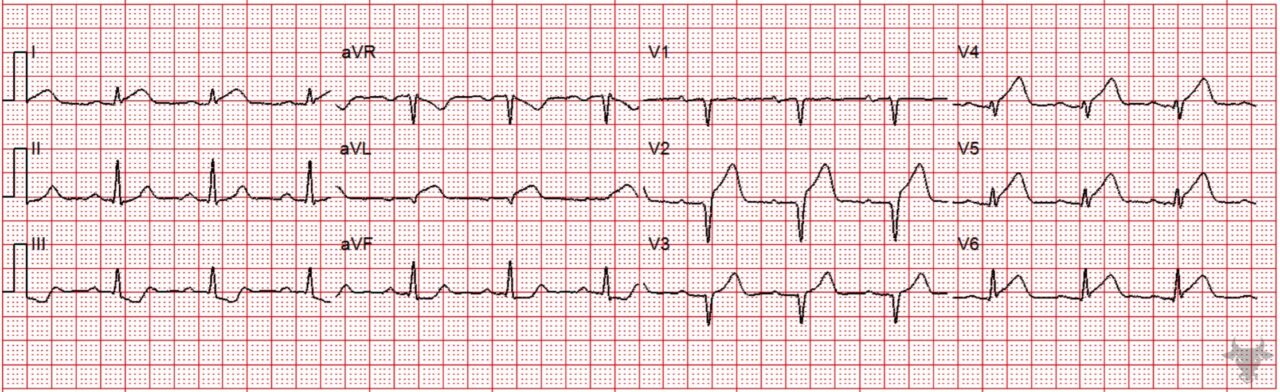 Hyperacute T Waves | ECG Stampede