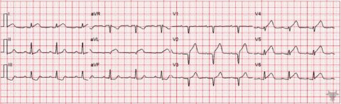 Hyperacute T Waves | ECG Stampede